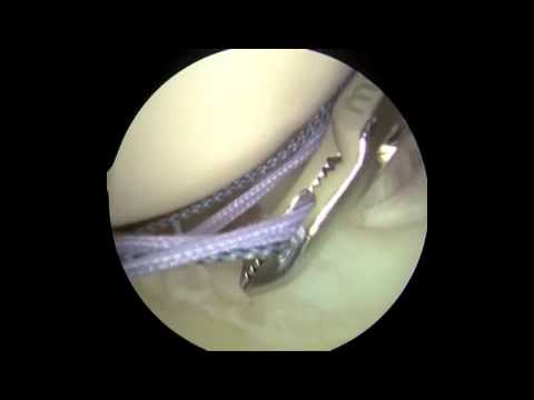 Subscap-SupraSpinatus