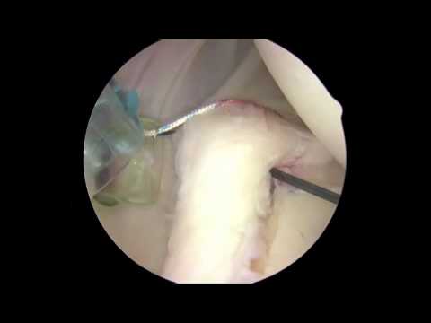 Posterior Bankart (Laberal Repair)
