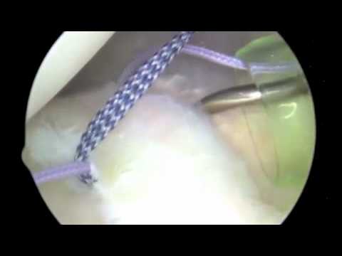 Posterior Instability