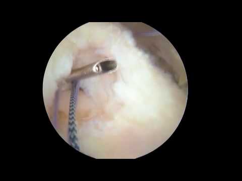 Crescent Shape Small Rotator Cuff Repair