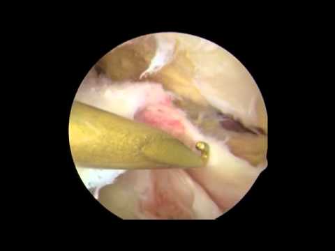 Large Rotator Cuff Tear