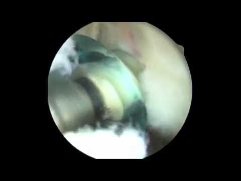 Rotator Cuff Repair with Biceps Tenodesis