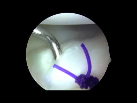 Anterior Posterior Capsular Plication