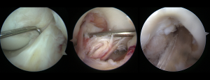 ACL Arthroscopic Treatment