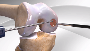 Knee Cartilage Restoration by Arthrex Knee Cartilage Restoration by Arthrex