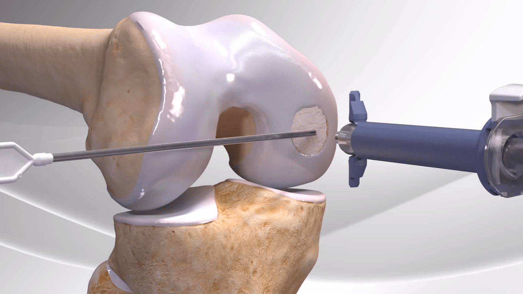 David Argo, M.D. Beacon Orthopaedics & Sports Medicine