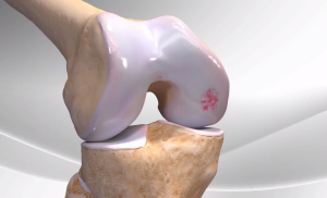 Arthrex Knee Cartilage Restoration Procedure Arthrex Knee Cartilage Restoration Procedure