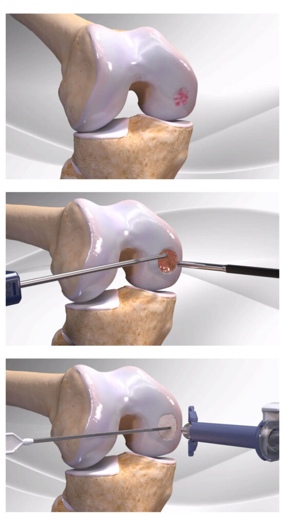 Arthrex Knee Cartilage Restoration