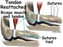 Bicep Tendon Reattached