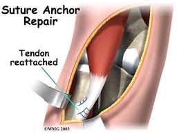 Biceps Tendon Repair Surgery