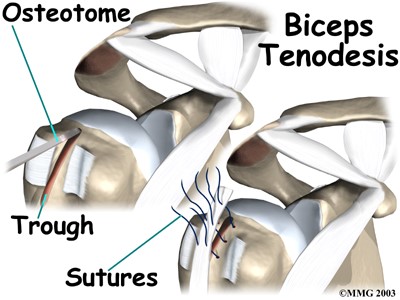 What is a Biceps Tendon Rupture and How is it Fixed?