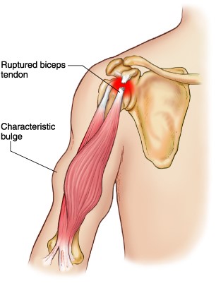 Bulging Bicep after Ruptured Tendon