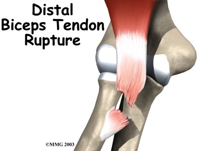 Distal Biceps Tendon Rupture