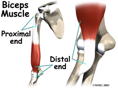 Distal Repair to Biceps Tendon Rupture