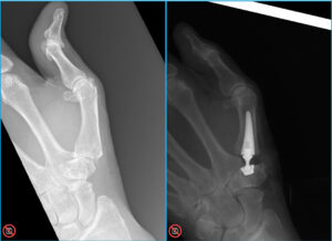 Side-by-side X-rays of a thumb before and after CMC joint replacement. The left image shows the arthritic joint at the base of the thumb with the joint space collapsed. The right image shows the metal implant seated in the thumb metacarpal.