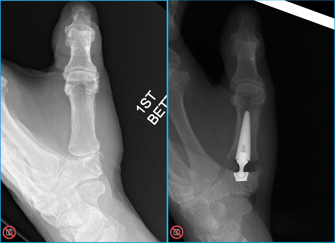 Close-up side-by-side X-rays of a thumb before and after CMC joint replacement. The left image shows the arthritic joint at the base of the thumb. The right image shows the implant stem and base component in place.