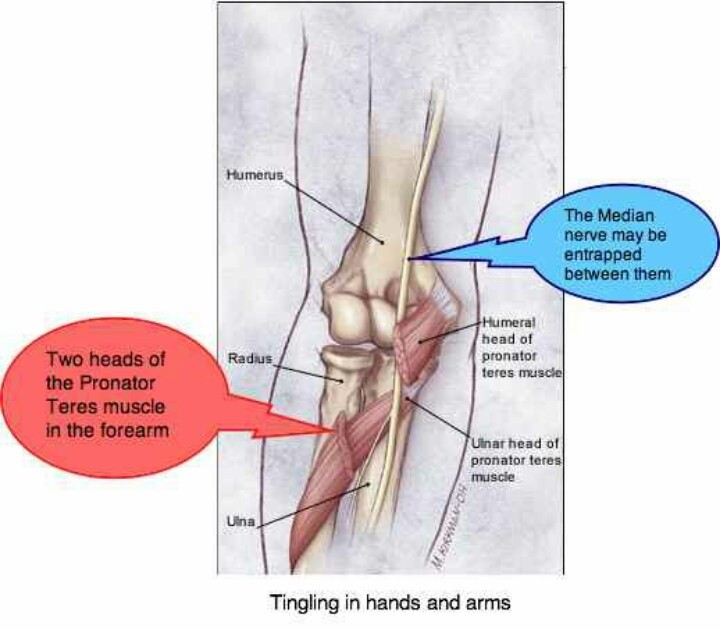 Elbow After Perineural Injection Therapy