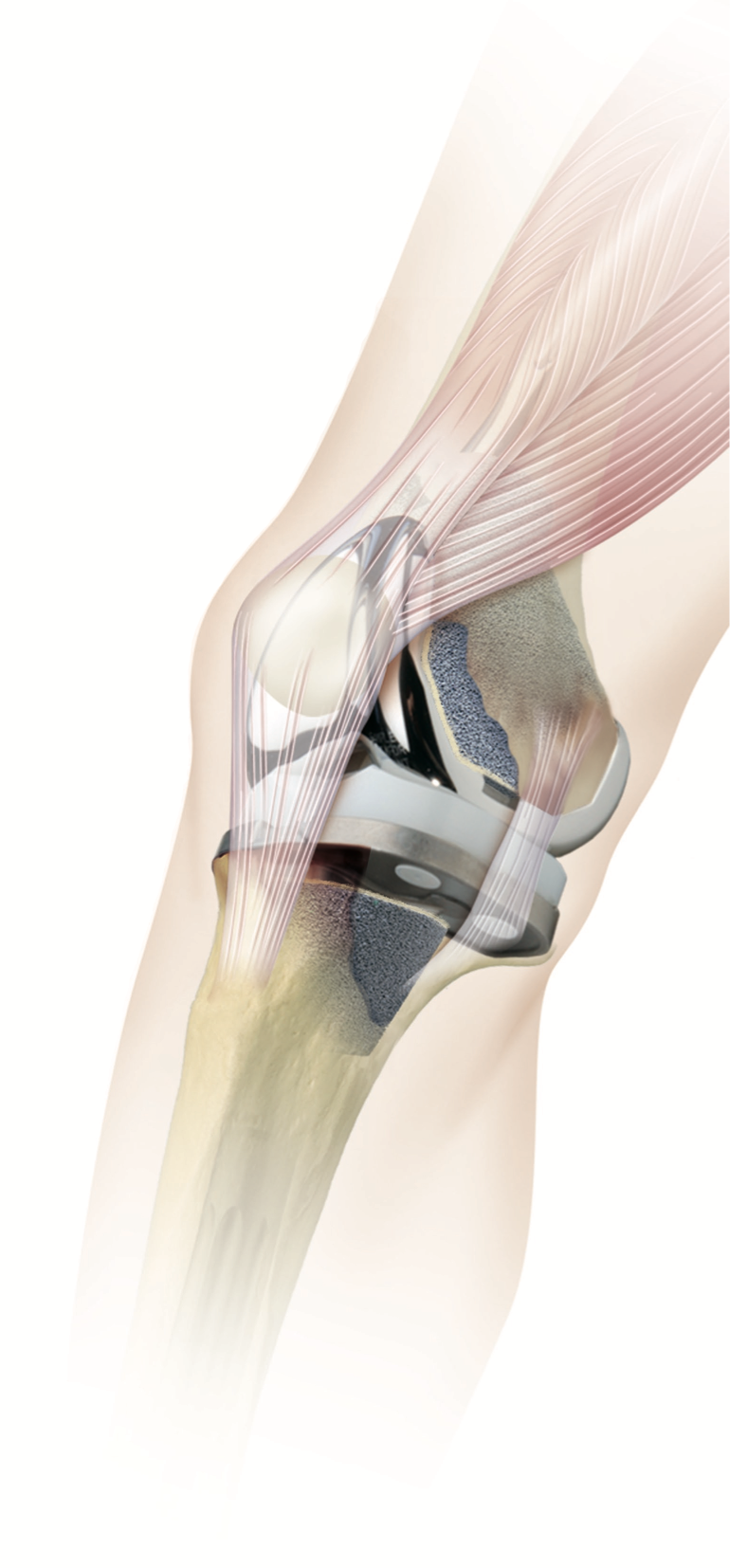 Knee-Replacement Knee-Replacement