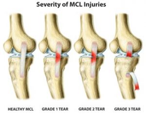 MCL Tear Rendering-Severity