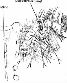 osteofibrous tunnel for perineural injection