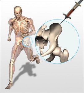 Regenexx Bone Marrow