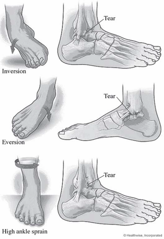 Anatomy of Ankle Sprains