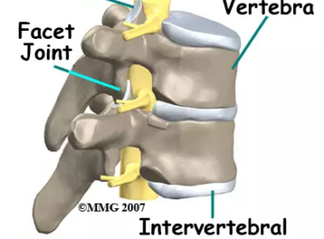 Scoliosis graphic