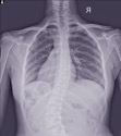 Scoliosis