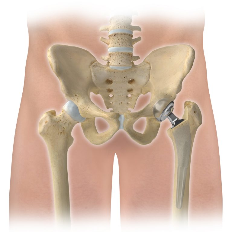 Hip Replacements May Require A Revision Why? Beacon Orthopaedics
