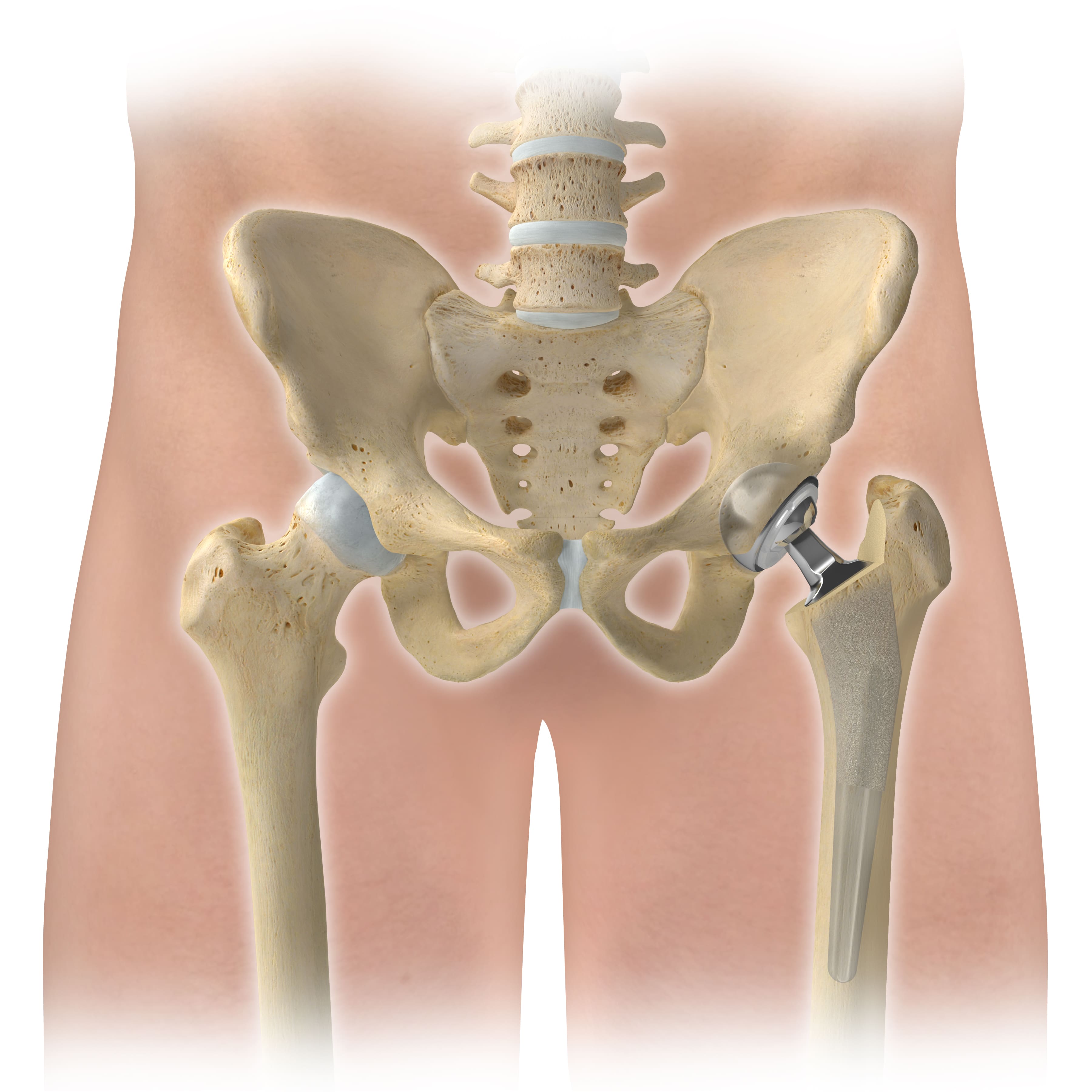 total hip replacement revision