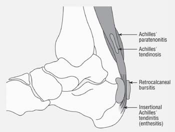 Image of the Achilles Tendon
