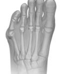 bunion treatment example