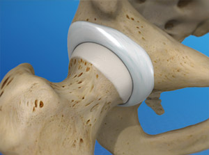 Healthy Hip Joint