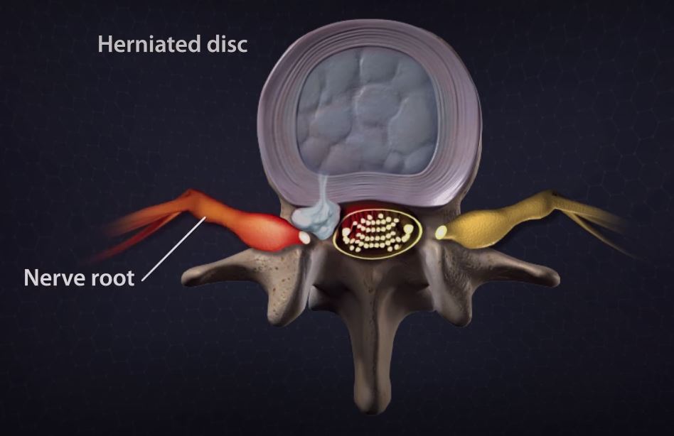 5 Herniated Disc Symptoms You Should Know