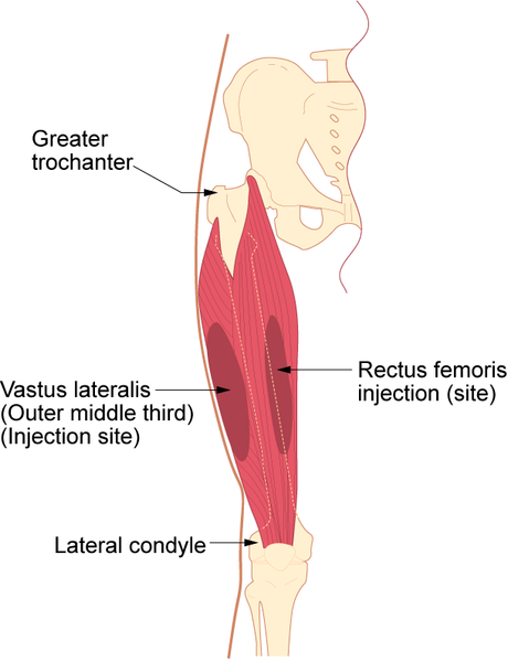 Issues Around The Hip From Tendonitis To Bursitis Beacon Orthopaedics Sports Medicine