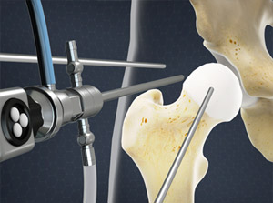 Hip Arthroscopy