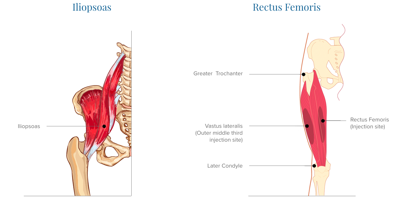 Tendinitis And Bursitis Treatment Cincinnati Tendinitis Dayton Oh