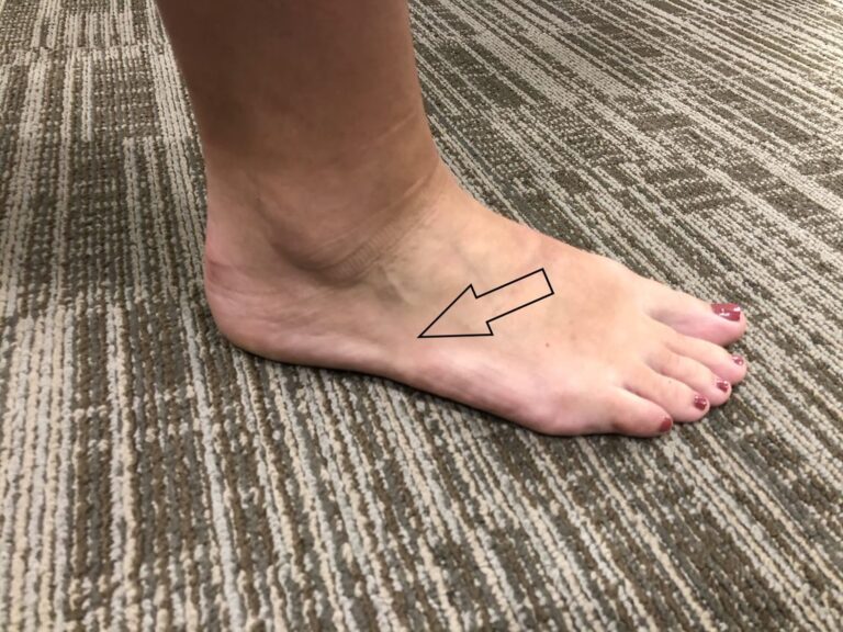 Does Your Foot Hurt Here? The Outside of the Foot