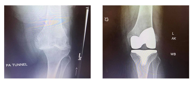 Before and After Knee Surgery