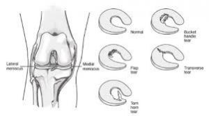 Meniscus Tear Diagram