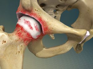 Osteoarthritis-Hip