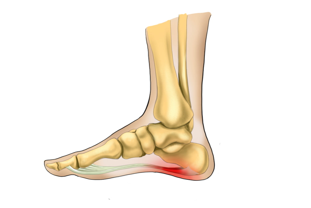 Cincinnati Plantar Fasciitis: Symptoms and Treatment in Dayton OH NKY