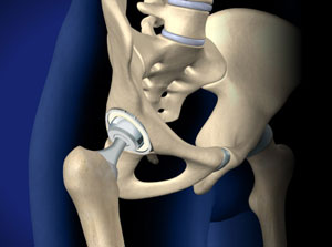 Total Hip Replacement-Anterior