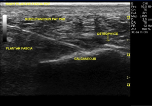 Percutaneous Needle Tenotomy Ultrasound