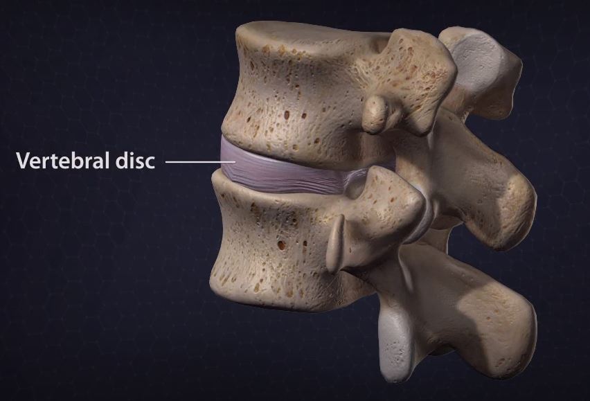 The Difference Between Herniated And Bulging Discs Beacon Orthopaedics